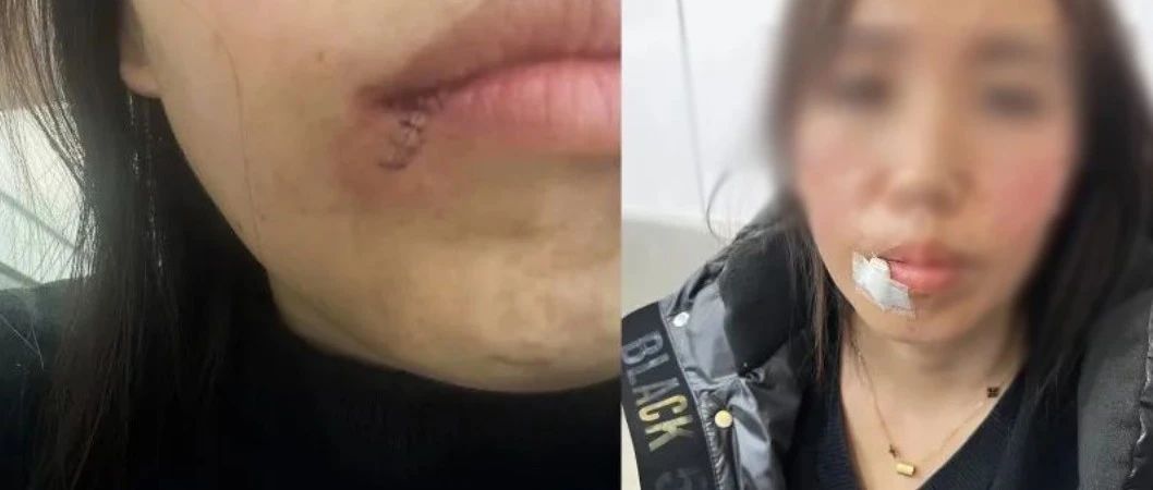 女子拔智齿后坐飞机创口高空爆血
