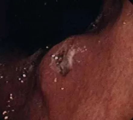 警惕！胃癌早期有何症状？这些信号千万别忽视！