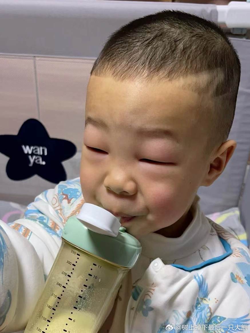 震惊！孩子一觉醒来脸肿成“发面馒头”，家长必看紧急处理指南