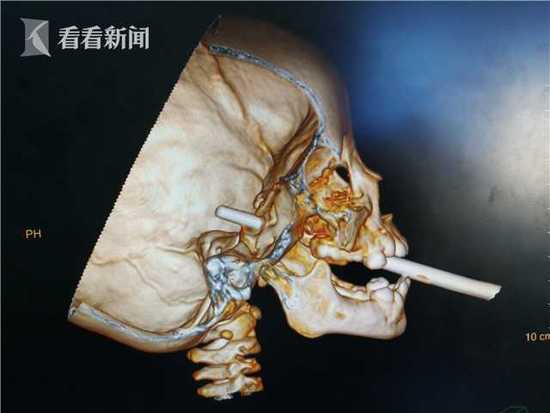 医学奇迹！女子大脑插6cm钢钉竟避开所有致命区域，专家揭秘背后真相