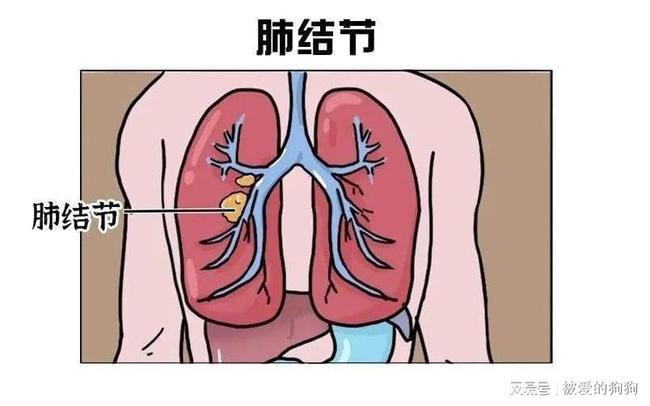 震惊！27岁女子肺结节没在意 1年后确诊肺癌，医生痛心疾首：这些信号别忽视！