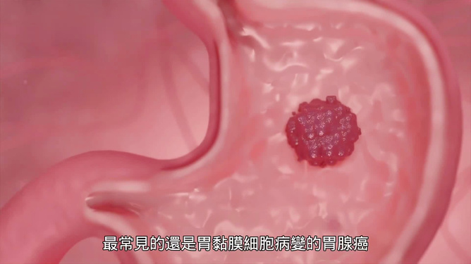 警惕！胃癌早期有何症状？这些信号千万别忽视！